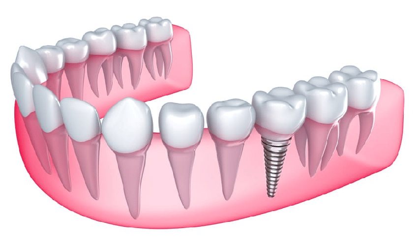 5 Reasons to Get Tooth Implants