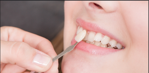 Popular Smile Makeover Treatments in Sydney: What’s Trending?